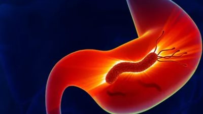  ما هي أعراض جرثومة المعدة؟