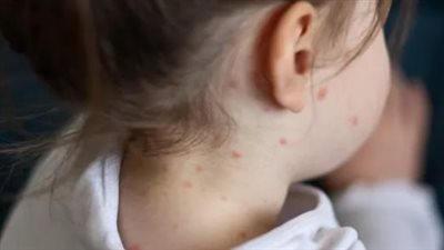 الولايات المتحدة الأمريكية تسجل أكثر من 800 إصابة بالحصبة منذ بداية 2025