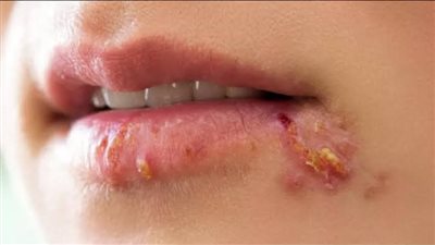 ما هو فيروس الهربس الفموي؟.. وأعراضه
