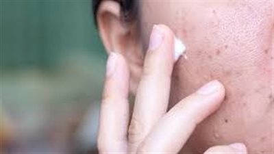 ازالة اثار الحبوب من الوجه