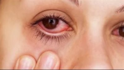 نصائح ذهبية لمرضى حساسية العين