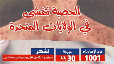 الحصبة تتفشى في الولايات المتحدة (انفوجراف)