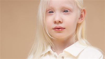 ما لا تعرفه عن الأطفال الألبينو.. 8 معلومات مهمة للطفل ووالديه