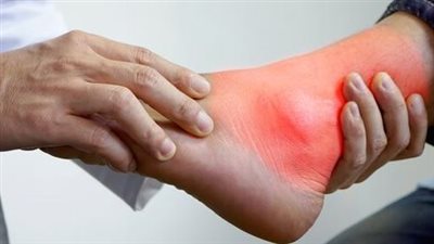 الوقاية من مرض النقرس في عيد الأضحى.. افعل ولا تفعل