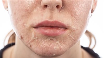 كيفية تقشير البشرة الحساسة في فصل الصيف.. خطوات ونصائح مهمة