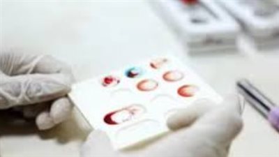  نتائج واعدة لاختبار دم بسيط قادر على اكتشاف مؤشرات مرض السرطان