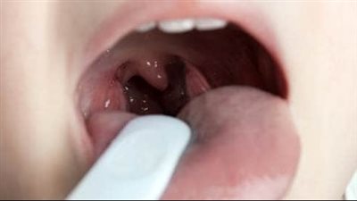 10 أطعمة لعلاج التهاب الحلق وما يجب تجنبه