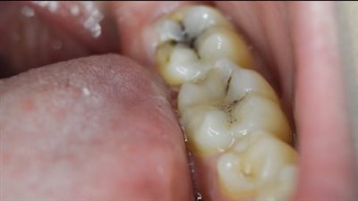 أسباب تسوس الأسنان.. كيفية حدوثه وعوامل خطر للإصابة به