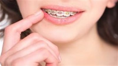 طريقة الأكل بعد تركيب تقويم الأسنان.. أطعمة مناسبة لمنع الألم