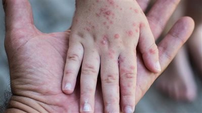 تعرف على الفرق بين الحصبة وجدري الماء.. الأعراض والعلاج
