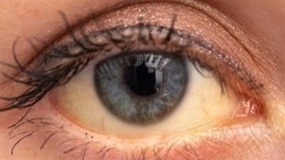 10 من أسباب اصفرار العين.. بعضها محفزات مرضية خطيرة