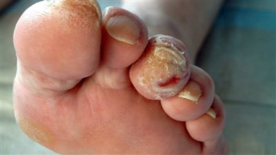 أعراض قدم السكري وطرق العناية بها في 12 خطوة