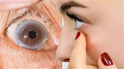 أعراض ارتفاع الكوليسترول.. 10 علامات يجب الانتباه لها 