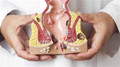 علاج البواسير بـ 10 خطوات فعالة وتدابير وقائية أخرى 