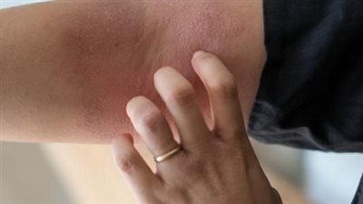 أعراض حساسية الأدوية وكيفية التعامل معها.. انتبه لها جيدًا