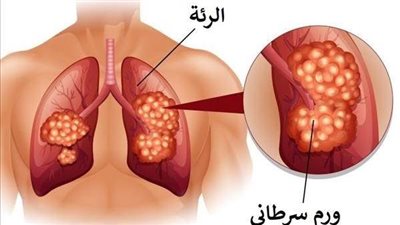 أسباب سرطان الرئة.. 7 عوامل خطيرة بخلاف التدخين