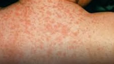 أنواع وأسباب التهاب السحايا