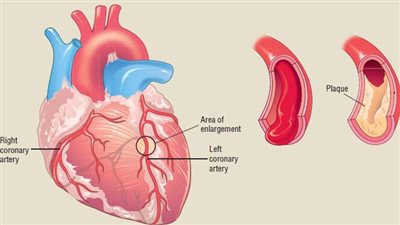 كيفية التعامل مع مرض الشريان التاجي.. الأعراض والأسباب والعلاج