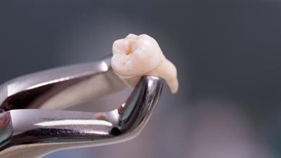 تفسير حلم وقوع الضرس