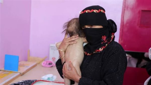 الكوليرا تفتك بمناطق سيطرة الحوثيين.. كارثة صحية تهدد السكان وسط إهمال متعمد