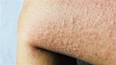 الشرى البارد.. اعرف الأسباب والأعراض والعلاج