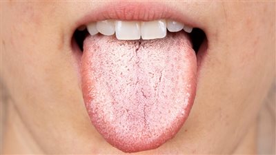 هل اللسان الأبيض علامة على الجفاف؟.. تعرف على الإجابة