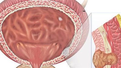 أعراض التهاب المثانة عند الإناث والذكور.. علامات خطيرة احذرها