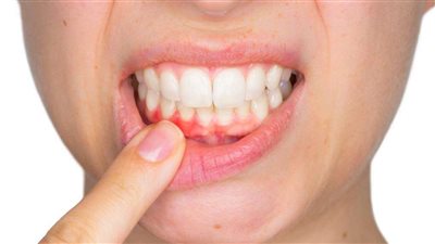 كيفية إيقاف نزيف اللثة.. 15 خطوة منزلية لا تفوتك