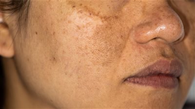 كيفية التخلص من فرط التصبغ.. 8 طرق معتمدة من قِبل الأطباء 