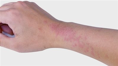 5 مشاكل جلدية مرتبطة بمرض السكري يجب أن تعرفها