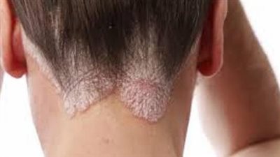 صدفية فروة الرأس.. دليلك الشامل لمعرفة أسبابها وأعراضها