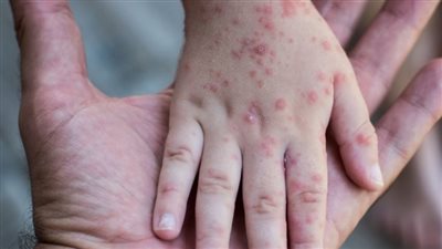 الهربس النطاقي.. تعرف على الأسباب والأعراض وسبل الوقاية