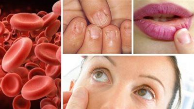 أسباب وأعراض فقر الدم المنجلي.. مرض وراثي يصيب خلايا الدم الحمراء