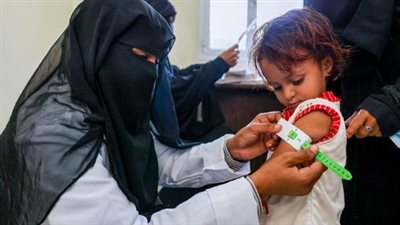 سوء التغذية.. أزمة إنسانية متفاقمة خلفتها الحرب الحوثية في اليمن
