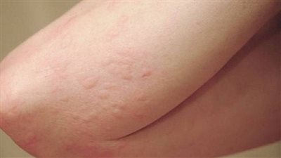 أعراض حساسية الجلوتين.. 13 علامة شائعة