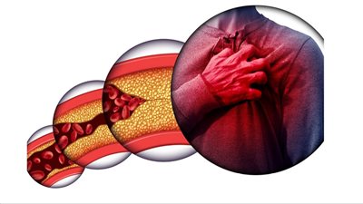 مضاعفات ارتفاع الكوليسترول.. 6 أمراض خطيرة أبرزها القلب والضغط