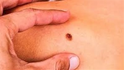 فهم سرطان الدم.. الأعراض والأسباب والأنواع