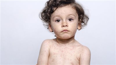 أسباب وأعراض الحصبة الألمانية.. طرق العلاج والوقاية