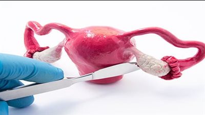 ما لا تعرفيه عن متلازمة تكيس المبايض.. أسبابها وأعراضها