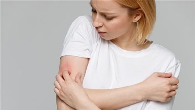 الفرق بين الحصبة والحساسية.. ما لا تعرفه عن الطفح الجلدي