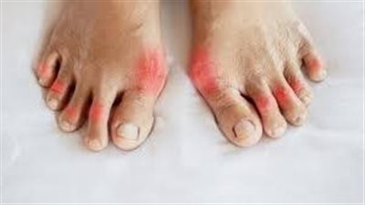 الروماتيزم في القدمين.. الأعراض التي يجب أن تعرفها