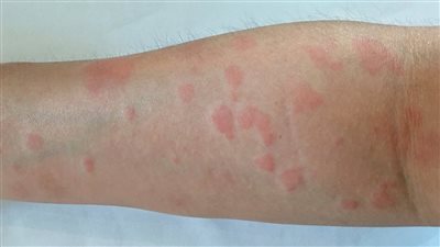 كل ما يتعلق بـ مرض الذئبة.. الأعراض والأسباب والعلاج