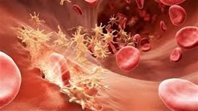 ما هو مرض الهيموفيليا؟ تعرف على الأعراض والأسباب 