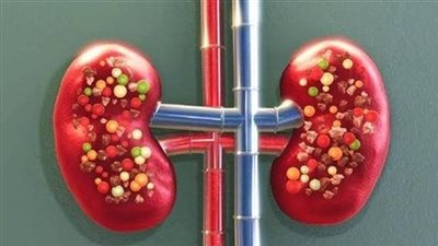 كل ما يتعلق بـ حصوات الكلى.. الأعراض والأسباب والوقاية والعلاج