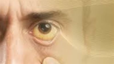 أهم أعراض فيروس A التي يجب الانتباه لها