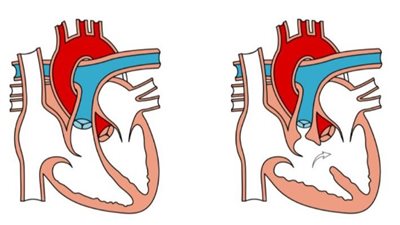 رباعية فالو.. تعرف على أسبابها وأعراضها 