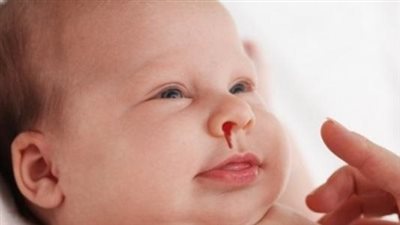 أسباب نزيف الأنف عند الأطفال.. عوامل شائعة وأخرى نادرة
