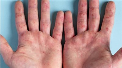 فيروس HFMD: كل ما تحتاج معرفته عن المرض المنتشر بين الأطفال