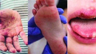 أعراض فيروس hfmd اليد والقدم والفم وطرق الوقاية منه