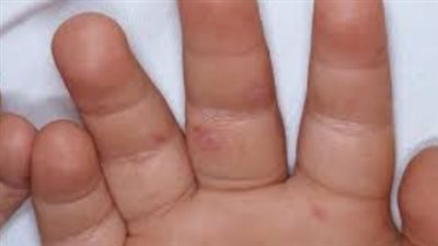 أسباب فيروس HFMD وكيفية انتقال العدوى بين الأطفال
